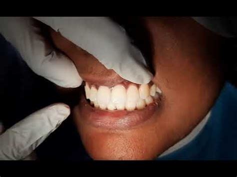Fremitus dental